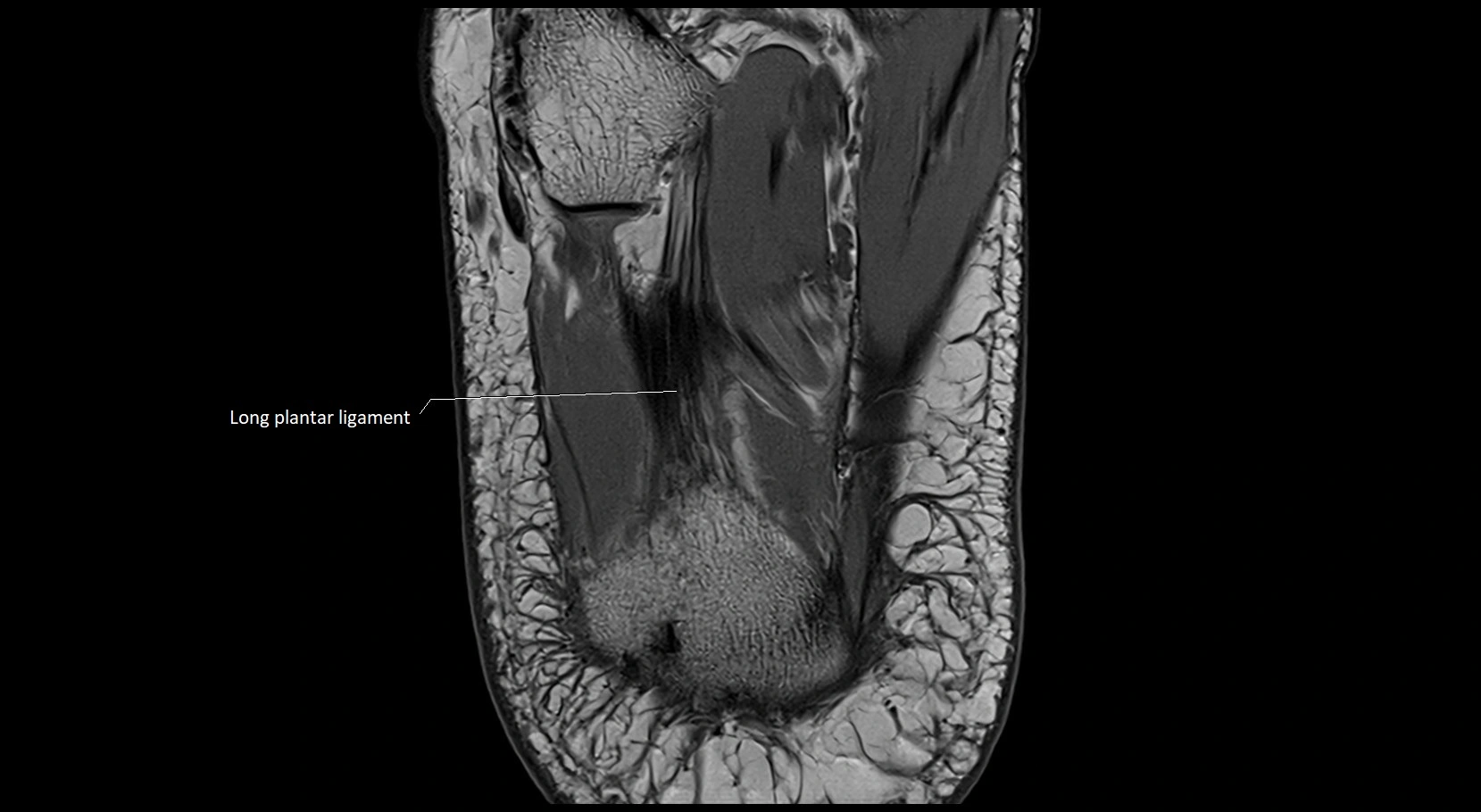 MRI ankle ligaments anatomy axial 3T image 27.webp